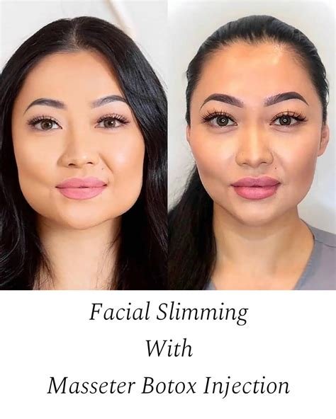 Sculptra for Sale