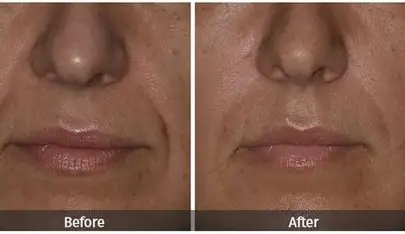 dermal fillers