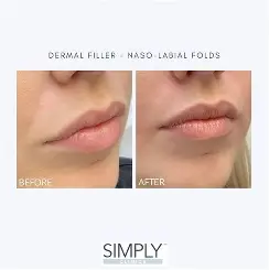 dermal fillers