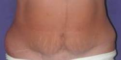 How Long Do Dermal Fillers Last