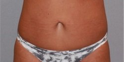 How Long Do Dermal Fillers Last