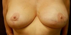 How Long Do Dermal Fillers Last