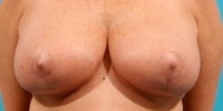 How Long Do Dermal Fillers Last