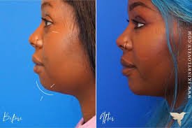 how dermal fillers work