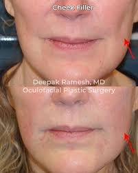 How Long Do Dermal Fillers Last