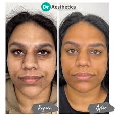how dermal fillers work
