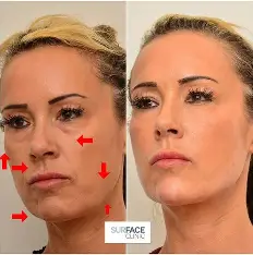 dermal fillers