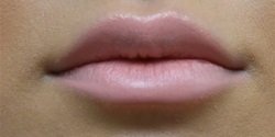 How Long Do Dermal Fillers Last