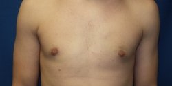 How Long Do Dermal Fillers Last