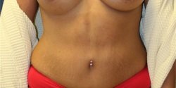 How Long Do Dermal Fillers Last