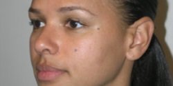 How Long Do Dermal Fillers Last